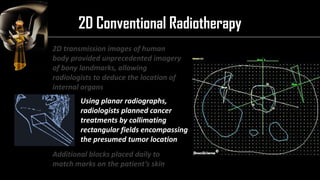 Intensity Modulated Radiation Therapy (IMRT) | PDF