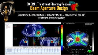 Intensity Modulated Radiation Therapy (IMRT) | PDF