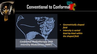 Intensity Modulated Radiation Therapy (IMRT) | PDF