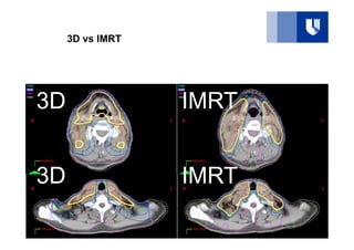 Intensity Modulated Radiation Therapy: Delivery Types .pdf