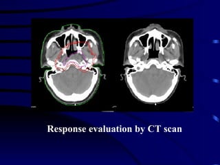 <ul><li>Response evaluation by CT scan </li></ul>