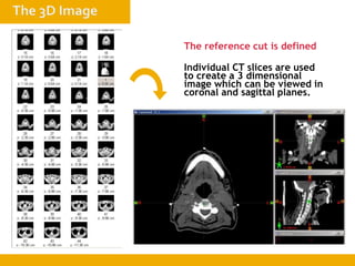 The reference cut is defined
Individual CT slices are used
to create a 3 dimensional
image which can be viewed in
coronal and sagittal planes.
 