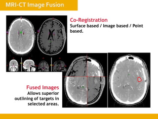 Co-Registration
Surface based / Image based / Point
based.
Fused Images
Allows superior
outlining of targets in
selected areas.
 