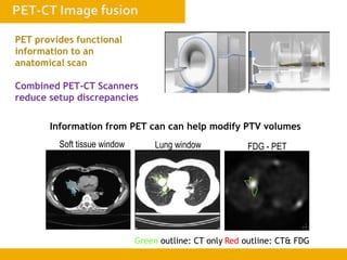 1
1
Siemens medical
Solutions that help
Non-Small Cell Carcinoma
Soft Tissue Window Lung Window
Courtesy of Universitaets-Klinikum Essen
Soft tissue window Lung window FDG - PET
Green outline: CT only Red outline: CT& FDG
PET provides functional
information to an
anatomical scan
Combined PET-CT Scanners
reduce setup discrepancies
Information from PET can can help modify PTV volumes
 