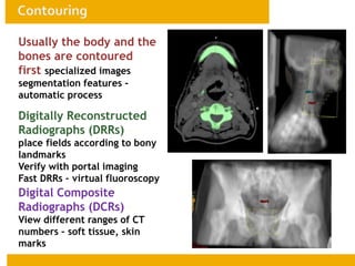 Usually the body and the
bones are contoured
first specialized images
segmentation features -
automatic process
Digitally Reconstructed
Radiographs (DRRs) –
place fields according to bony
landmarks
Verify with portal imaging
Fast DRRs – virtual fluoroscopy
Digital Composite
Radiographs (DCRs) –
View different ranges of CT
numbers – soft tissue, skin
marks
 