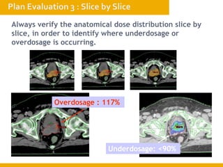 Always verify the anatomical dose distribution slice by
slice, in order to identify where underdosage or
overdosage is occurring.
Overdosage : 117%
Underdosage: <90%
 