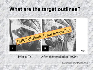 What are the target outlines? IMRT difficult, if not impossible Prior to Txt After chemoradiation (40Gy) K Narayan and Quinn 2003 