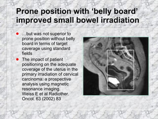 Prone position with ‘belly board’ improved small bowel irradiation … but was not superior to prone position without belly board in terms of target caverage using standard fields The impact of patient positioning on the adequate coverage of the uterus in the primary irradiation of cervical carcinoma: a prospective analysis using magnetic resonance imaging.  Weiss E et al Radiother. Oncol. 63 (2002) 83 