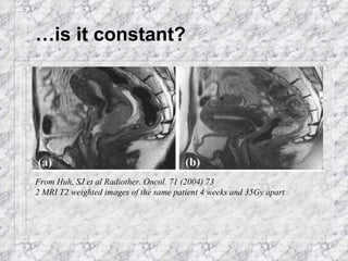 …is it constant? From Huh, SJ et al Radiother. Oncol. 71 (2004) 73 2 MRI T2 weighted images of the same patient 4 weeks and 35Gy apart 