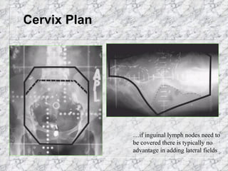 Cervix Plan … if inguinal lymph nodes need to be covered there is typically no advantage in adding lateral fields  