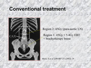Conventional treatment Mutic S et al IJROBP 55 (2003) 28 Region 2: 45Gy (para-aortic LN) Region 1: 45Gy + 5.4Gy EBT + brachytherapy boost 
