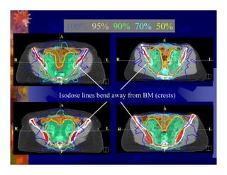 Imrt In Gynecologic Malignancies