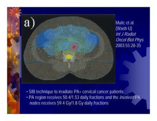 Imrt In Gynecologic Malignancies