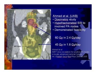 Imrt In Gynecologic Malignancies