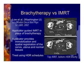 Imrt In Gynecologic Malignancies