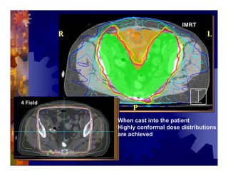 Imrt In Gynecologic Malignancies