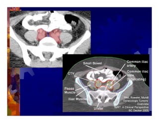 Imrt In Gynecologic Malignancies