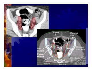Imrt In Gynecologic Malignancies