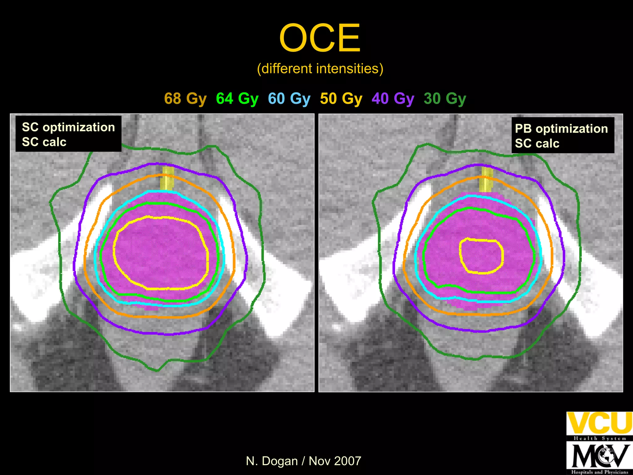OCE (different intensities) SC optimization SC calc PB optimization  SC calc 68 Gy   64 Gy   60 Gy   50 Gy   40 Gy   30 Gy 