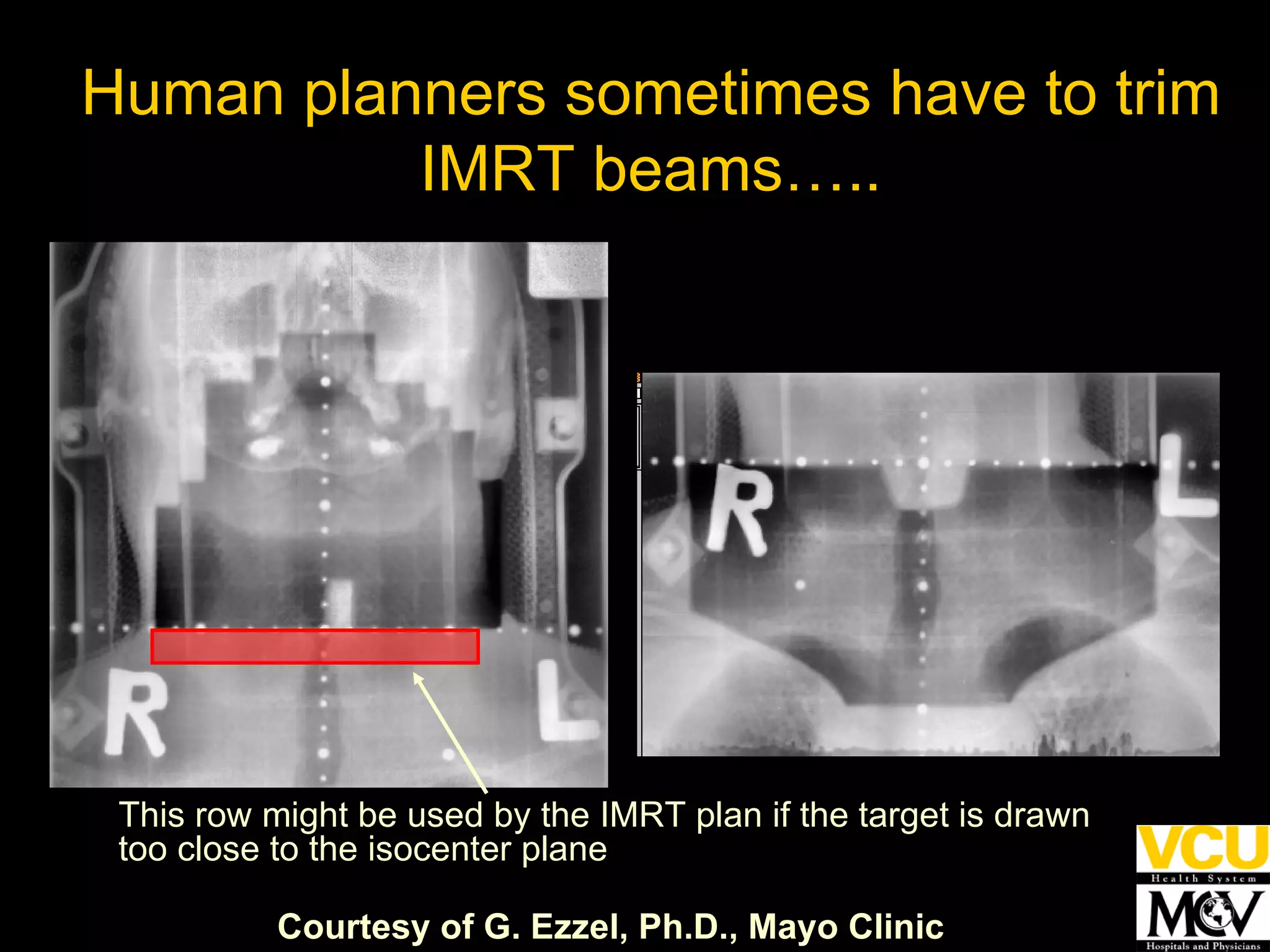 This row might be used by the IMRT plan if the target is drawn too close to the isocenter plane Courtesy of G. Ezzel, Ph.D., Mayo Clinic Human planners sometimes have to trim IMRT beams….. 