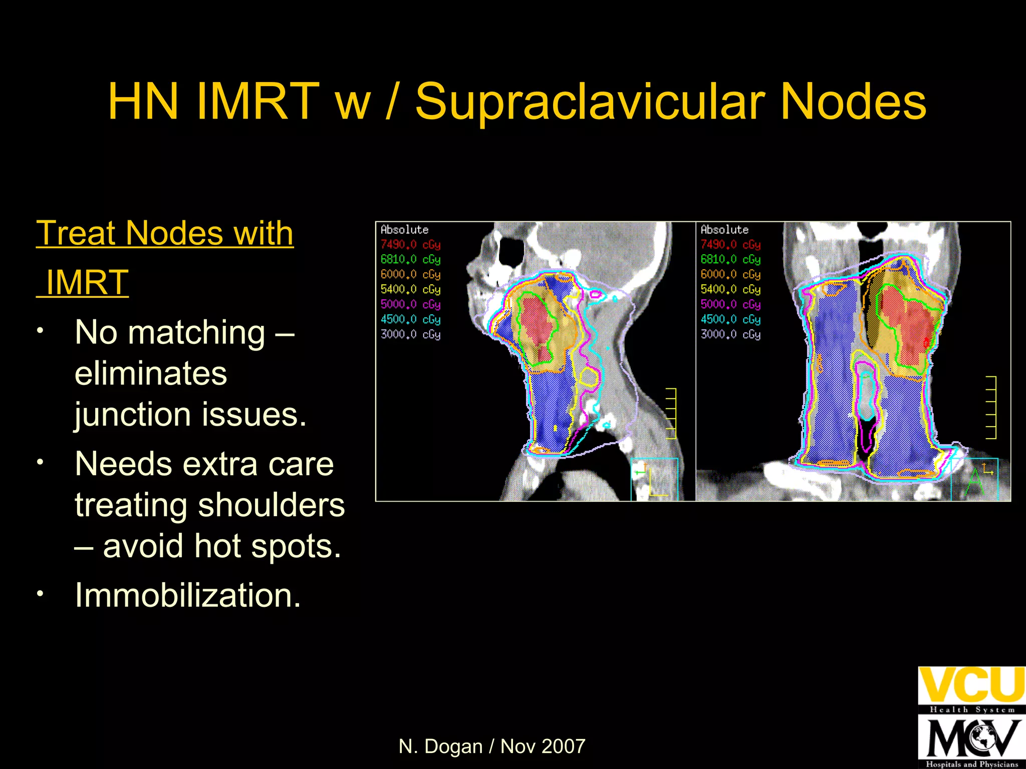 HN IMRT w / Supraclavicular Nodes Treat Nodes with IMRT No matching – eliminates junction issues. Needs extra care treating shoulders – avoid hot spots.  Immobilization. 