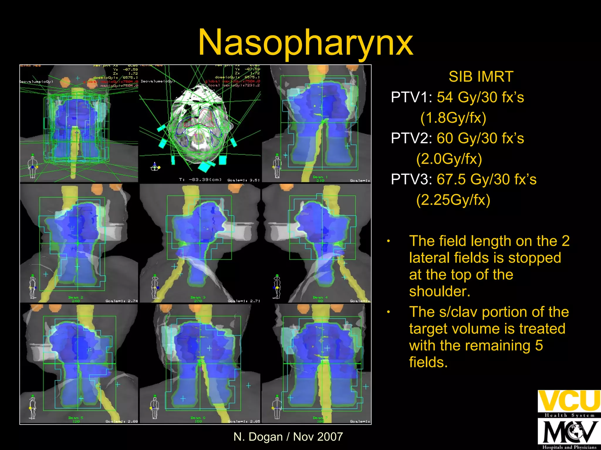 SIB IMRT PTV1:  54 Gy/30 fx’s (1.8Gy/fx) PTV2:  60 Gy/30 fx’s (2.0Gy/fx) PTV3:  67.5 Gy/30 fx’s  (2.25Gy/fx) The field length on the 2 lateral fields is stopped at the top of the shoulder. The s/clav portion of the target volume is treated with the remaining 5 fields. Nasopharynx 