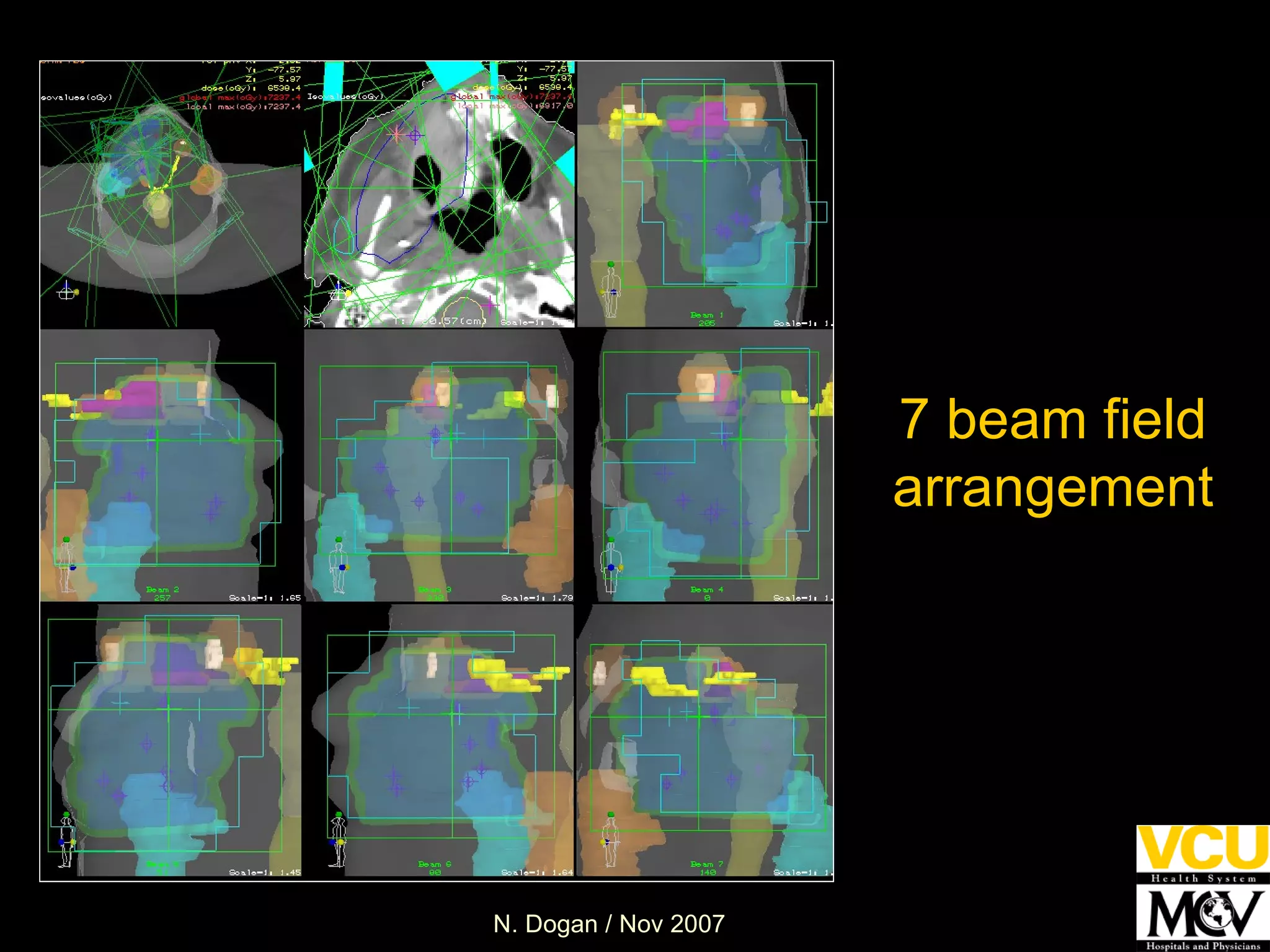 7 beam field arrangement 