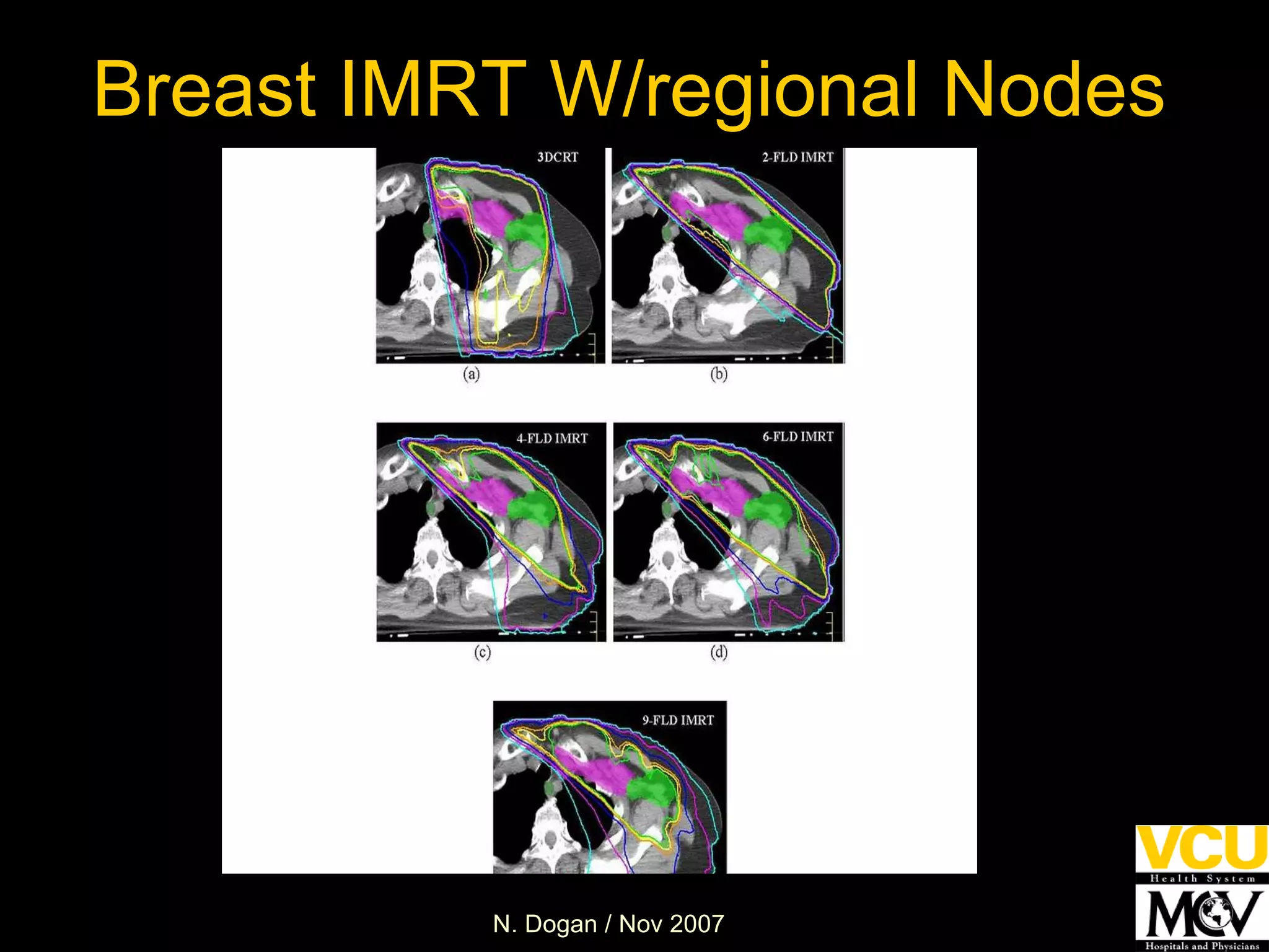 Breast IMRT W/regional Nodes 