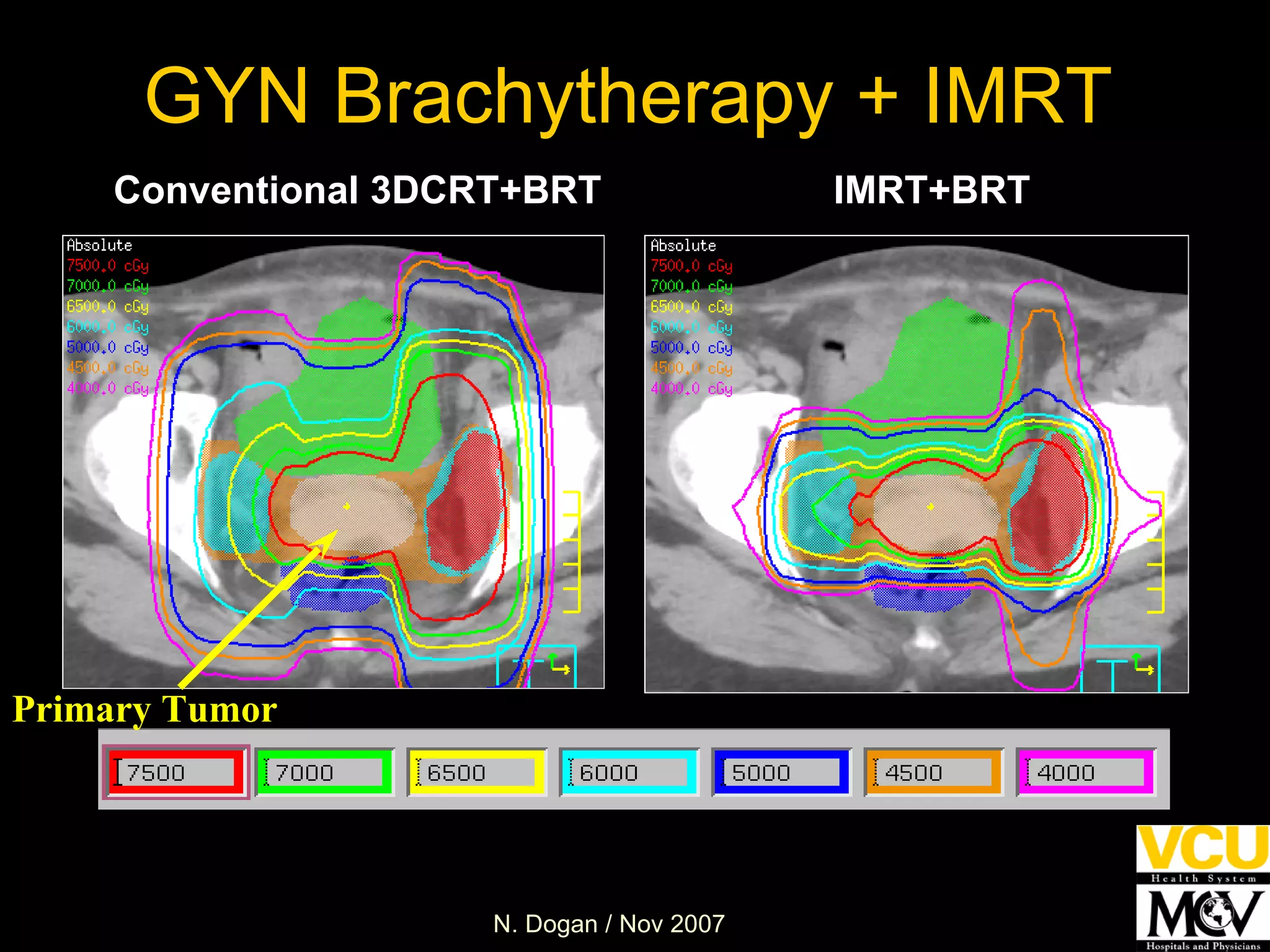 GYN Brachytherapy + IMRT IMRT+BRT Conventional 3DCRT+BRT Primary Tumor 