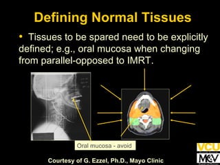Oral mucosa - avoid Courtesy of G. Ezzel, Ph.D., Mayo Clinic Defining Normal Tissues Tissues to be spared need to be explicitly defined; e.g., oral mucosa when changing from parallel-opposed to IMRT. 