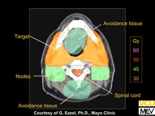 Target Nodes Spinal cord Avoidance tissue Avoidance tissue Gy 60 50 45 30 Gy 60 50 45 30 Courtesy of G. Ezzel, Ph.D., Mayo Clinic 