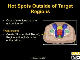 Hot Spots Outside of Target Regions Occurs in regions that are not contoured. Work-around Create “Unspecified Tissue” Region and include in the optimization. 