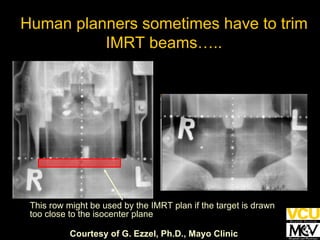 This row might be used by the IMRT plan if the target is drawn too close to the isocenter plane Courtesy of G. Ezzel, Ph.D., Mayo Clinic Human planners sometimes have to trim IMRT beams….. 