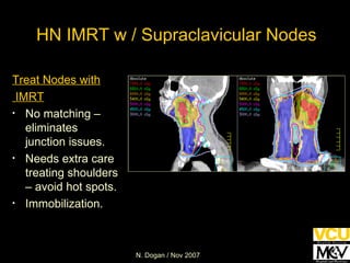 HN IMRT w / Supraclavicular Nodes Treat Nodes with IMRT No matching – eliminates junction issues. Needs extra care treating shoulders – avoid hot spots.  Immobilization. 