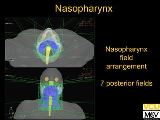 Nasopharynx Nasopharynx field arrangement 7 posterior fields 