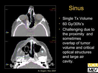 Sinus Single Tx Volume 60 Gy/30fx’s Challenging due to the proximity  and sometimes overlap of tumor volume and critical optical structures and large air cavity. 