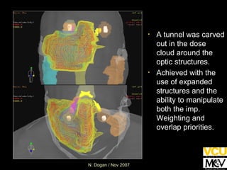 A tunnel was carved out in the dose cloud around the optic structures. Achieved with the use of expanded structures and the ability to manipulate both the imp. Weighting and overlap priorities. 