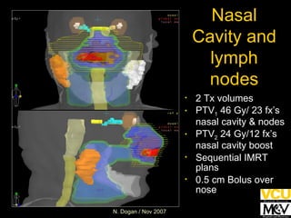 Nasal Cavity and lymph nodes 2 Tx volumes PTV 1  46 Gy/ 23 fx’s nasal cavity & nodes PTV 2  24 Gy/12 fx’s nasal cavity boost Sequential IMRT plans 0.5 cm Bolus over nose 