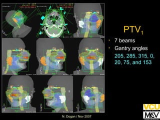 PTV 1 7 beams Gantry angles 205, 285, 315, 0, 20, 75, and 153 