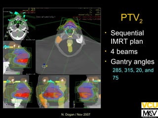 PTV 2 Sequential IMRT plan 4 beams Gantry angles 285, 315, 20, and 75 