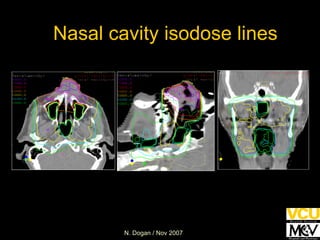 Nasal cavity isodose lines 