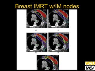 Heart IM nodes Heart IM nodes Breast IMRT w/IM nodes 