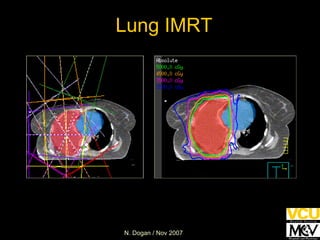 Lung IMRT 
