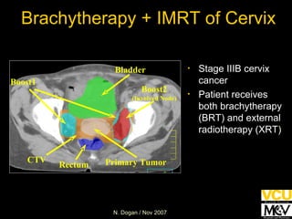 Boost1 Primary Tumor Bladder Rectum CTV Brachytherapy + IMRT of Cervix Stage IIIB cervix cancer Patient receives both brachytherapy (BRT) and external radiotherapy (XRT ) Boost2 (Involved Node) 