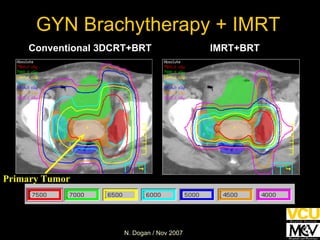 GYN Brachytherapy + IMRT IMRT+BRT Conventional 3DCRT+BRT Primary Tumor 