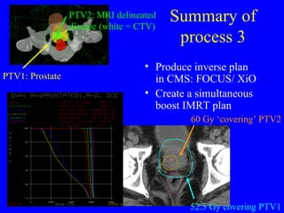 Imrt Where Next Image Guided Radiotherapy | PPT
