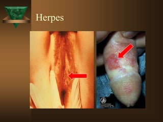 Herpes
 