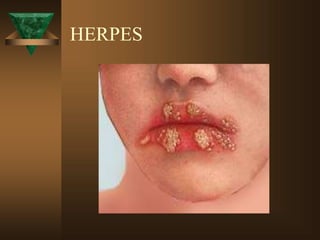 HERPES
 