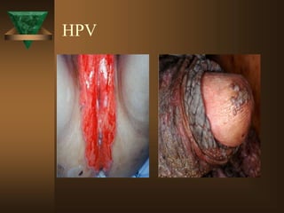 HPV
 