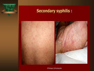 STD/Kespro II/Promkes/Atn
STD/Kespro II/Promkes/Atn
Secondary syphilis :
Secondary syphilis :
 